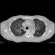 Pneumocystis pneumonia: CT - Computed tomography